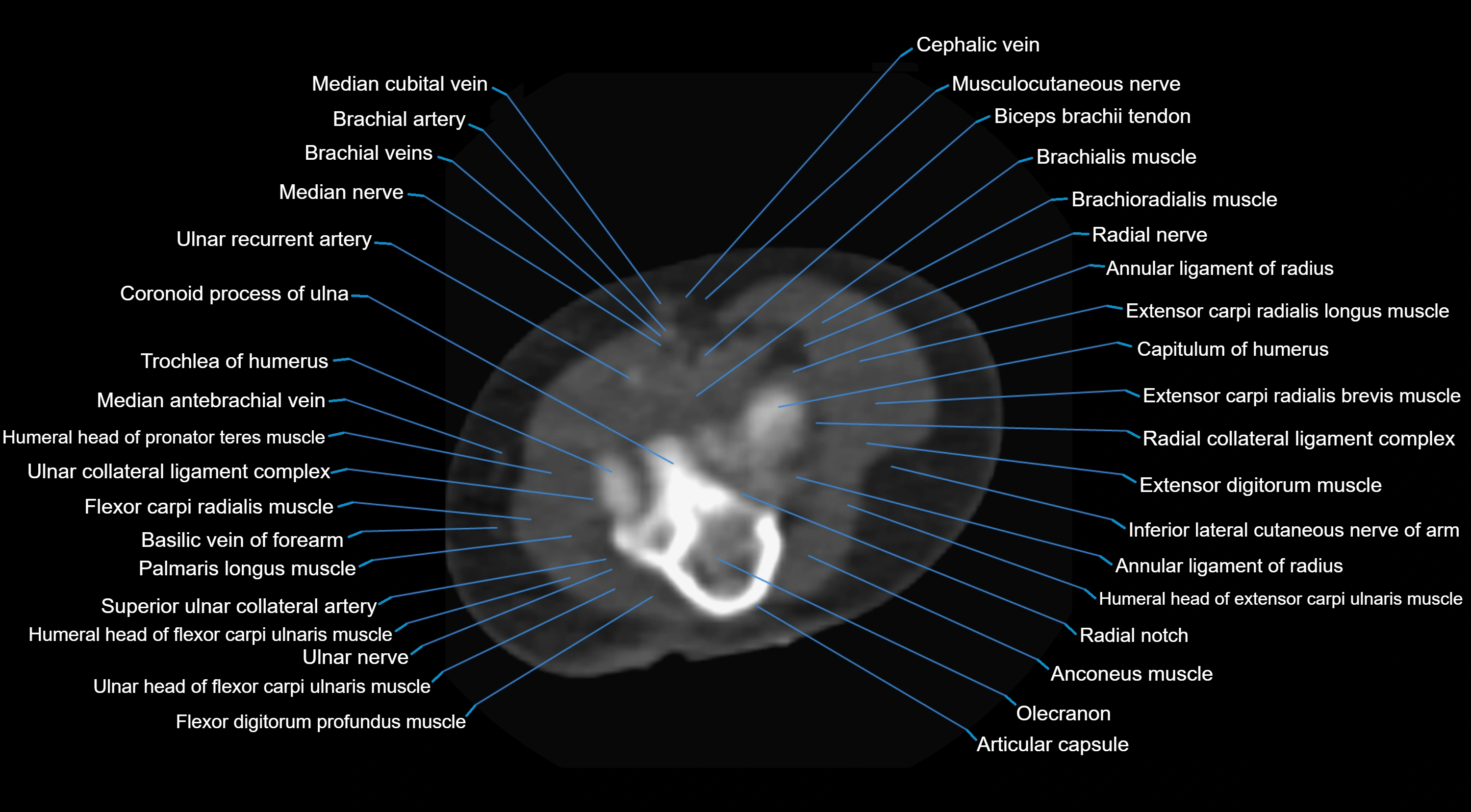CT elbow axial  cross sectional anatomy labelled  radiology image -00028.webp